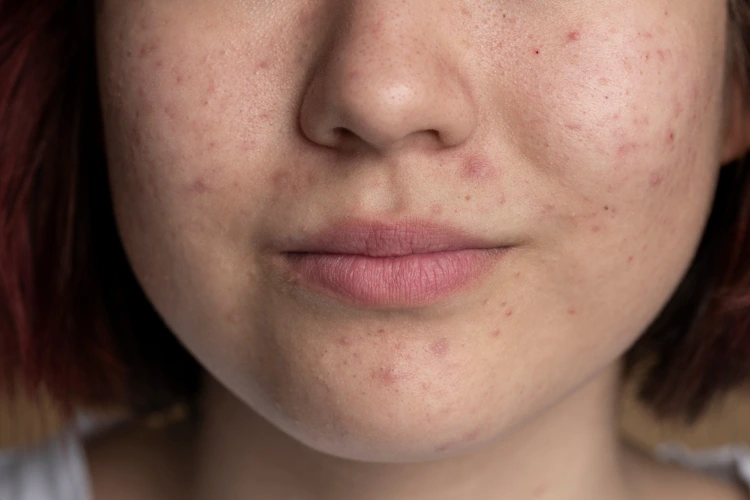 Close up view of a lady having acne scars on her face.