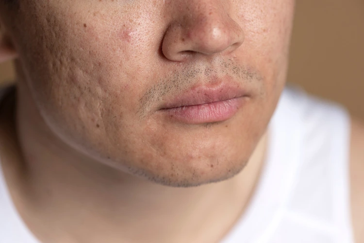 Man with acne scars on his face.