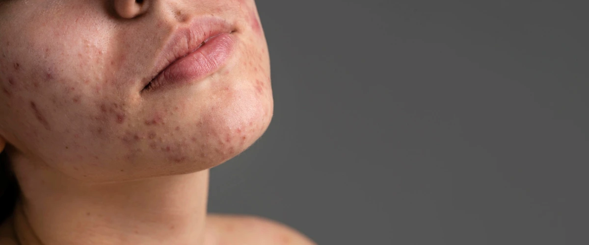 Lady suffering from severe acne scars on her face.