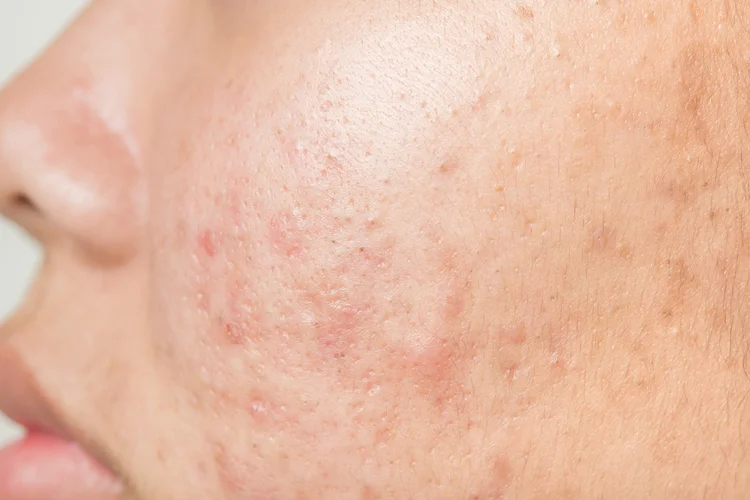 Acne scars on cheek illustrating skin texture that can improve over 3 to 6 months with treatment.