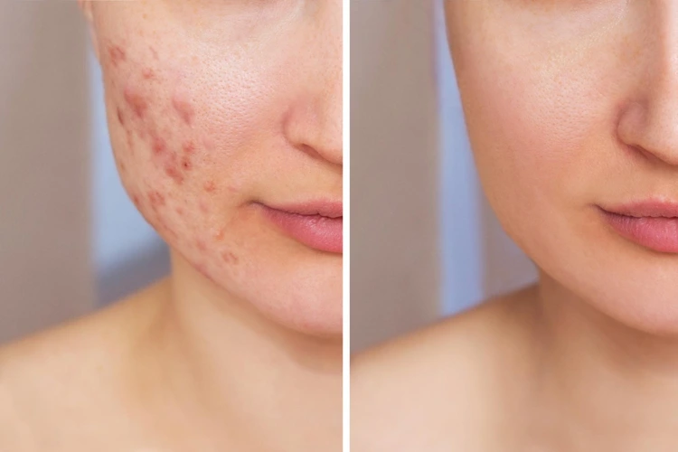 Before and after picture of lady undergoing acne treatment.
