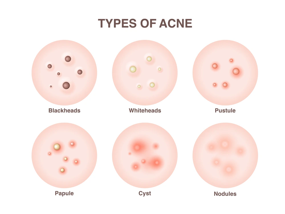 Various types of acne, including Blackheads, Whiteheads, Pustule, Papule, Cyst and Nodules.