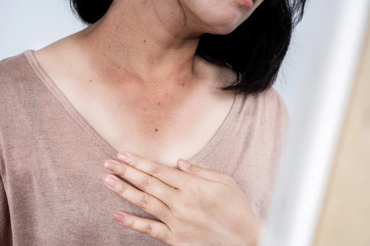 Asian woman with tanned skin showing melasma patches on neck from hormonal and sun exposure.