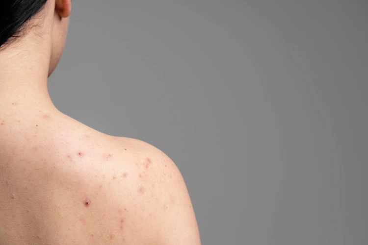 Back of a woman's right shoulder area with acne and acne scars.