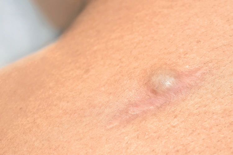 Presence of a cyst on the shoulder blade of a lady.