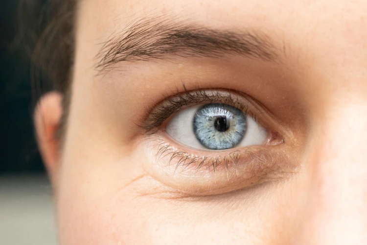 Close up view of a lady with dark circles and eye bags below her eye.