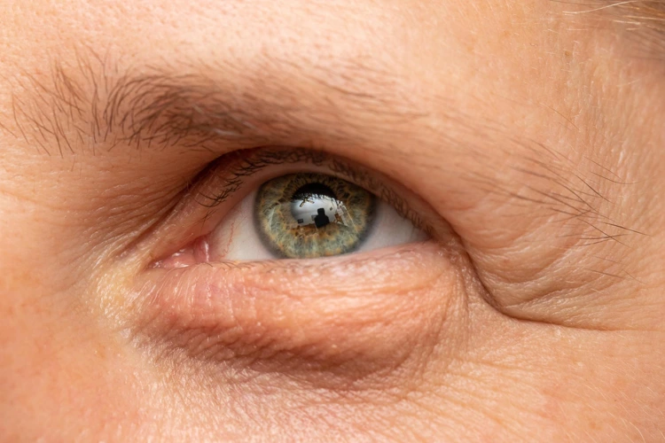 Close up view of a man with visible eye bags below his eye.