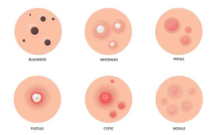 Illustration comparing types of acne including blackheads whiteheads papules pustules cysts nodules.