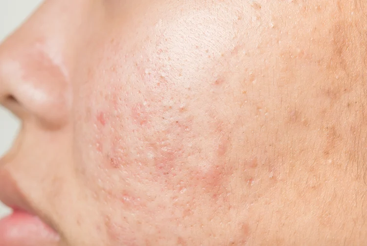 Inflamed acne lesions on woman's cheek demonstrating common symptoms of nodular acne breakouts.