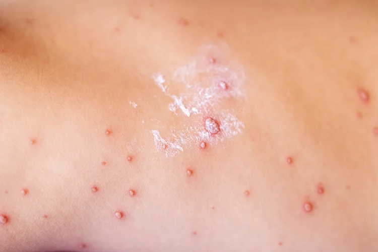 Cluster of inflamed chicken pox lesions on back showing risk of scarring from skin infection.