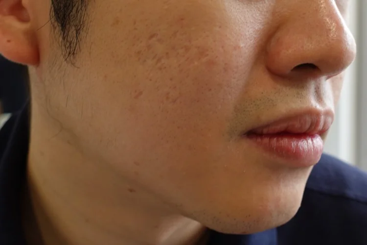 Man with rolling and boxcar acne scars.