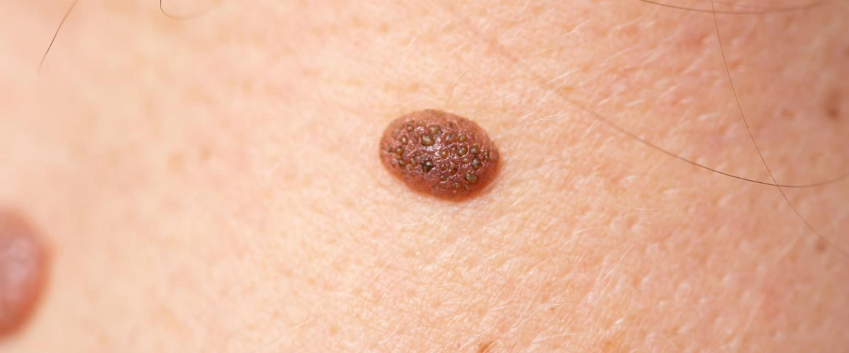 Close up view of mole of person's skin.