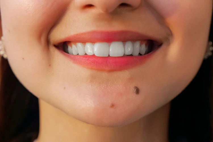 Lady with a noticeable mole between her lower lip and chin area.