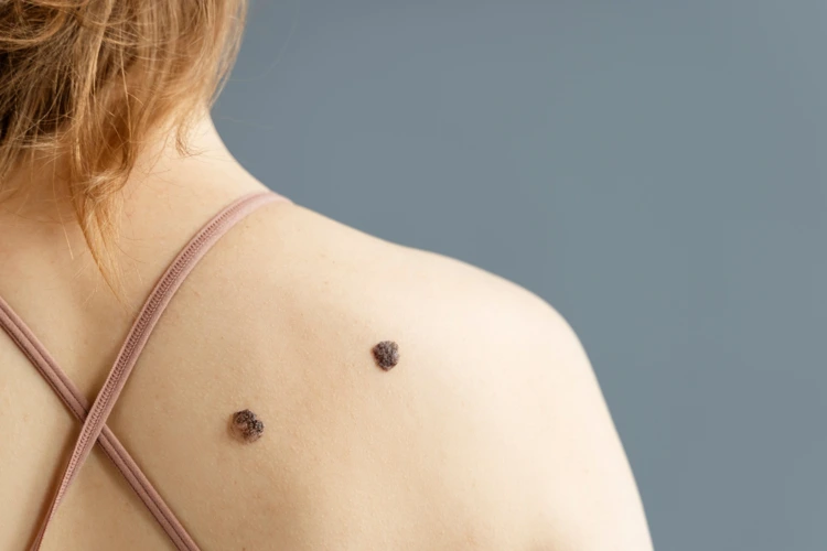 Lady with 2 big and noticeable moles on her back near her right shoulder.