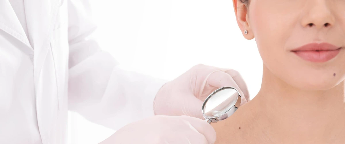 Dermatologist examining patient's mole with a magnifying glass.
