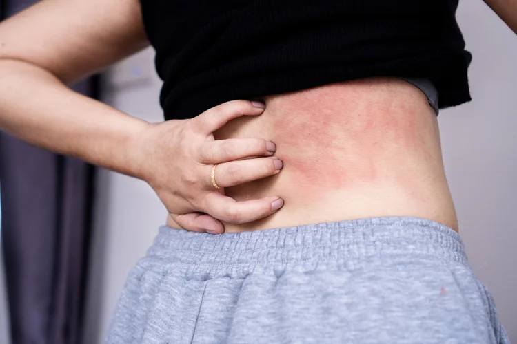 Person scratching red heat rash on lower back due to blocked sweat ducts in humid Singapore weather.