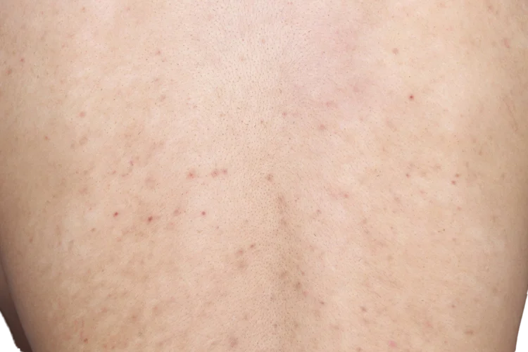 Post-inflammatory hyperpigmentation (PIH) on the back due to back acne.