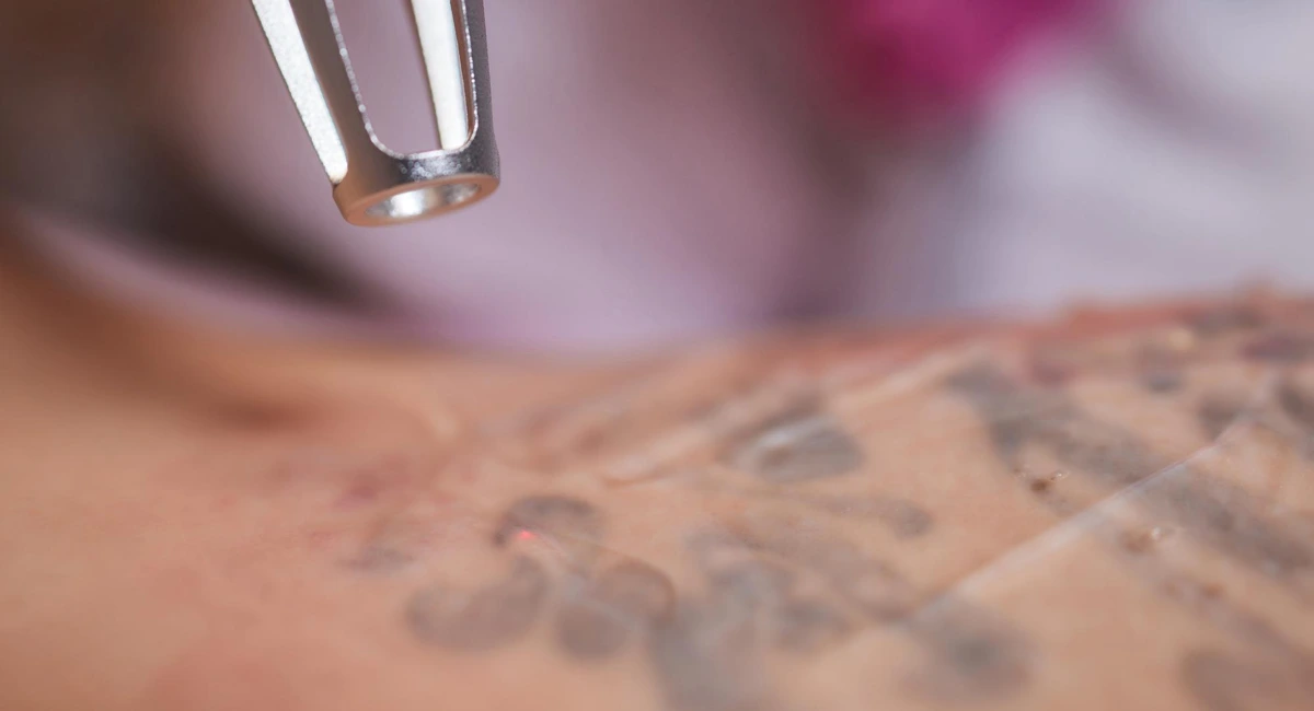 Patient undergoing laser tattoo removal at clinic.