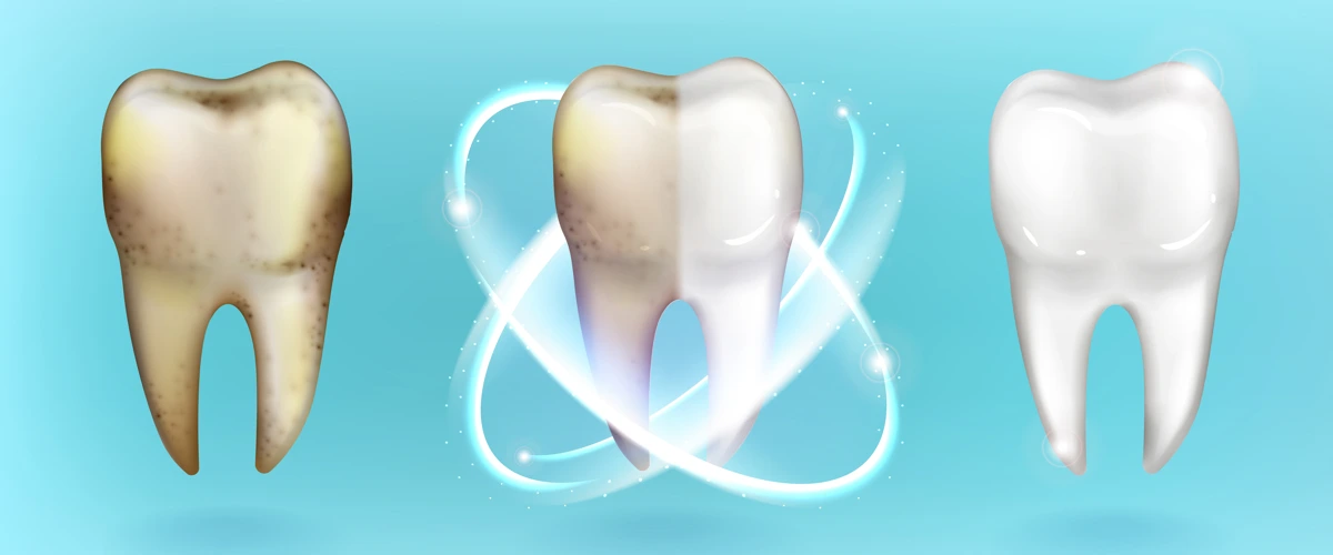 Process of yellow and stained teeth undergoing teeth whitening process to become shiny and healthy.