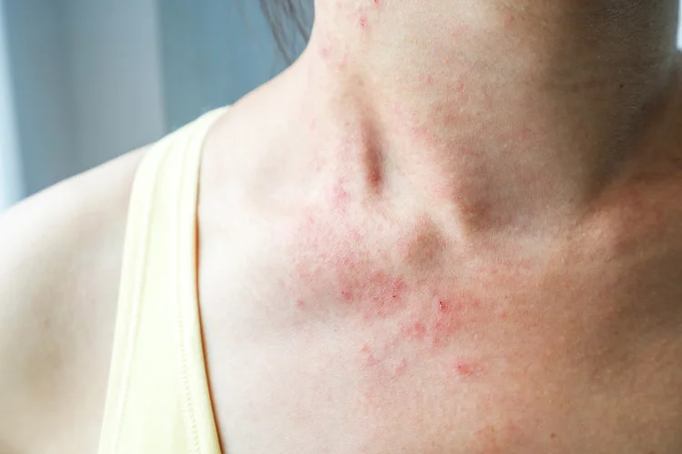 Woman showing heat rash on neck and upper chest with small red bumps due to sweat and friction.
